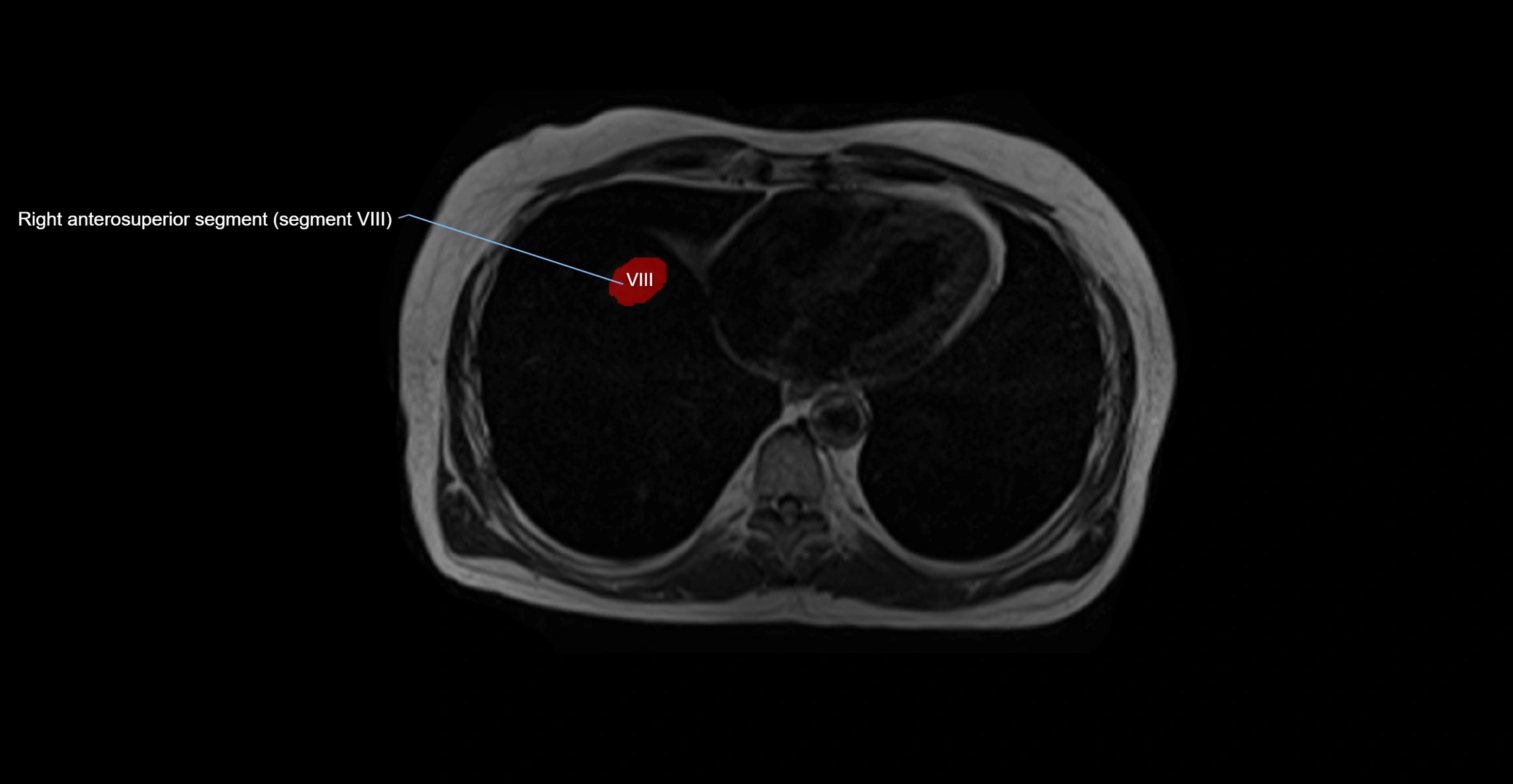 MRI  liver segments anatomy axial cross sectional 3T radiology  image-img-00001-00001.webp